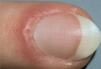 Paronychie / Inflammation superficielle au pourtour de l'ongle